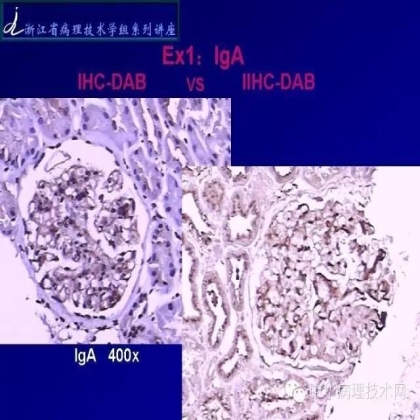探讨免疫组织学在肾穿标本中的应用
