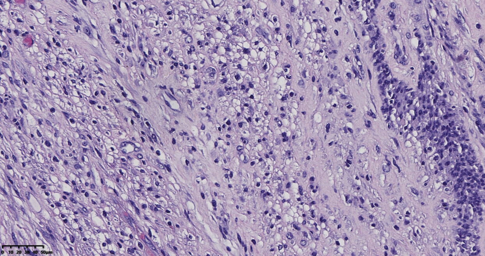 子宫多发性平滑肌瘤伴肉瘤