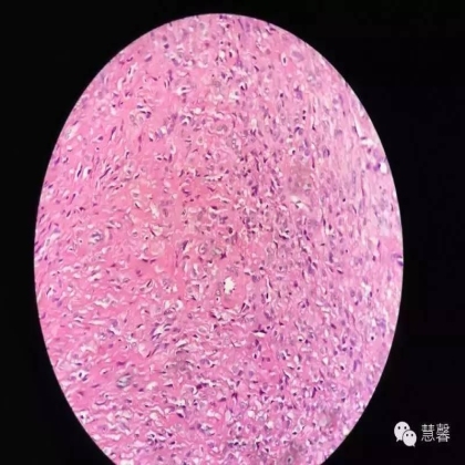 子宫腺肉瘤【吴梅娟】分享；【刘从容】老师讲解）