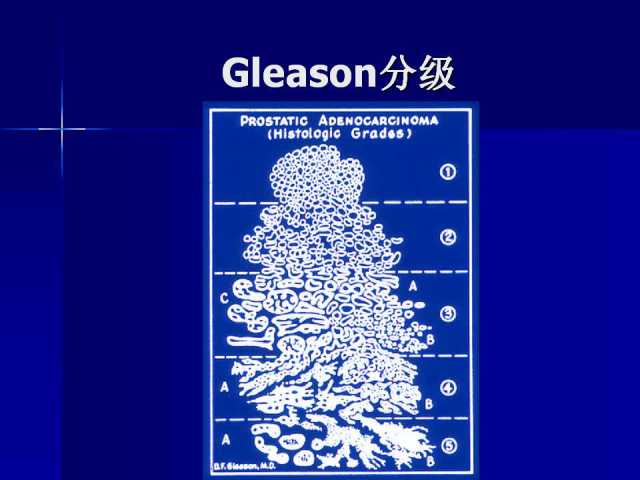 前列腺病理诊断线索（下）——黄教悌