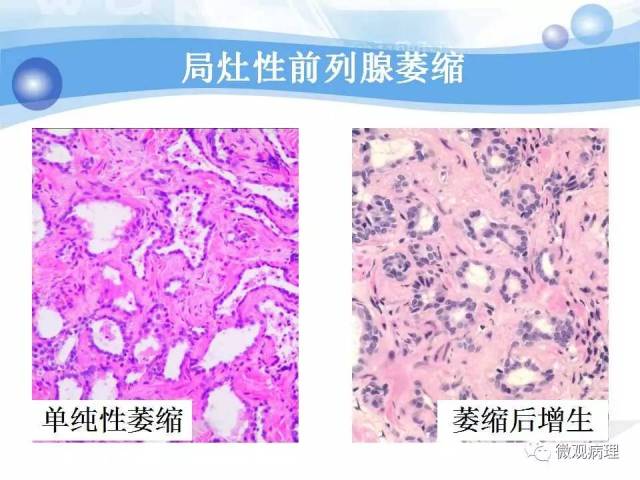 泌尿课程/局灶性前列腺萎缩