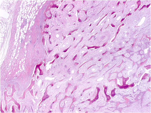 粗针穿刺活检中类似乳腺化生性癌的骨化性肌炎一例