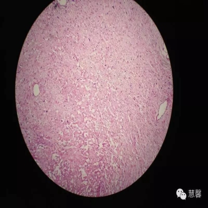 子宫内膜乳头状增生（甜甜分享病例，孔祥田(Max)*Roswell*老师讲解，kent翻译整理文献）