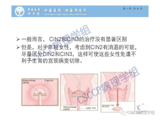 宫颈癌前病变中的诊断难点及阴道镜中ECC的 应用价值