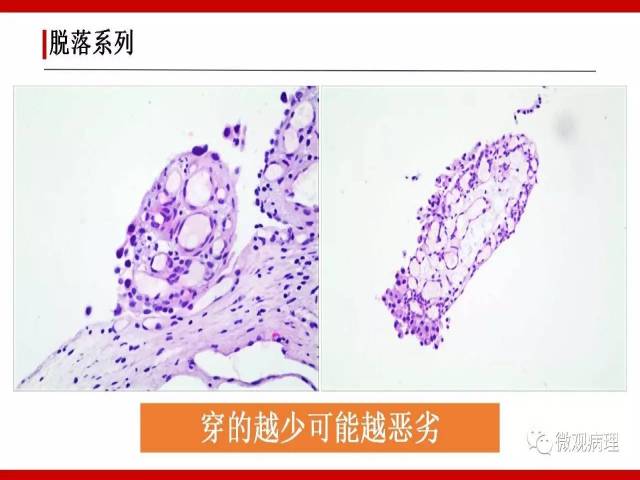 泌尿课程/非浸润性尿路上皮病变诊断的一些困惑