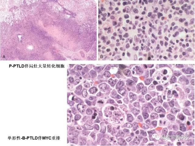 免疫缺陷相关淋巴组织增殖性疾病