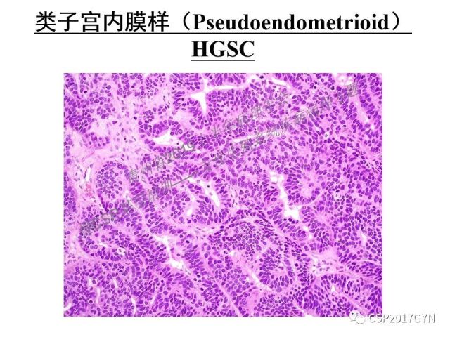 中华病理学会基层培训遵义站讲座（一）——卵巢和输卵管浆液性肿瘤的诊断和鉴别诊断