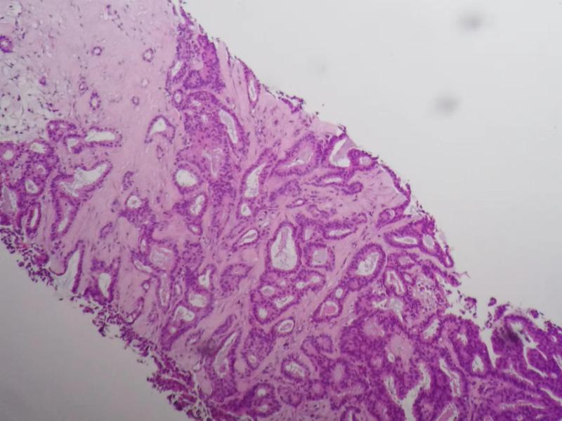 组织学1级的乳腺浸润性导管癌（札记七十五）