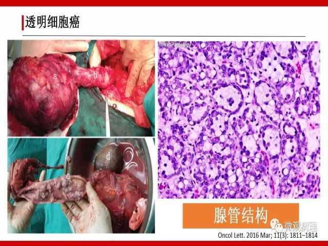 泌尿课程/尿路腺样病变的诊断要点