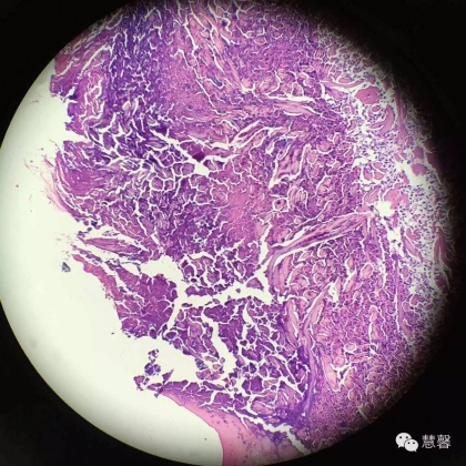 Acquired perforating dermatosis（孔祥田(Max)*Roswell*NM]分享及讲解）
