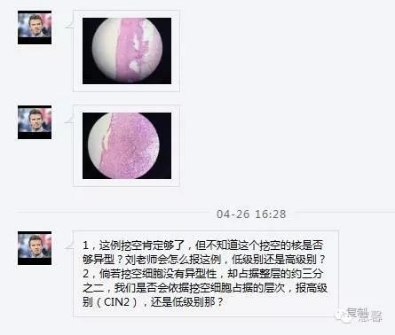 HPV感染挖空细胞形成的机制及其与对SIL级别判断的影响（孔令英分享病例，刘从容老师讲解）