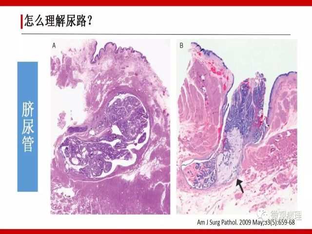 泌尿课程/尿路腺样病变的诊断要点