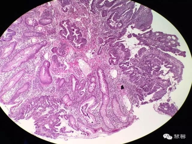 结、直肠管绒毛状腺瘤-高级别病变诊断等相关问题2（悄悄分享、孔祥田(Max)*Roswell*老师讲解）