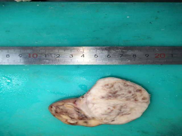 子宫多发性平滑肌瘤伴肉瘤