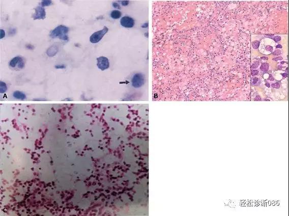 组织细胞起源疾病（25）——增生性病变（NDP）