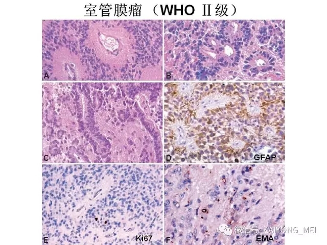 2016 WHO中枢神经系统肿瘤分类解读（三）