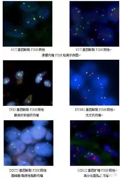 软组织肉瘤辅助诊断方法——FISH探针系列