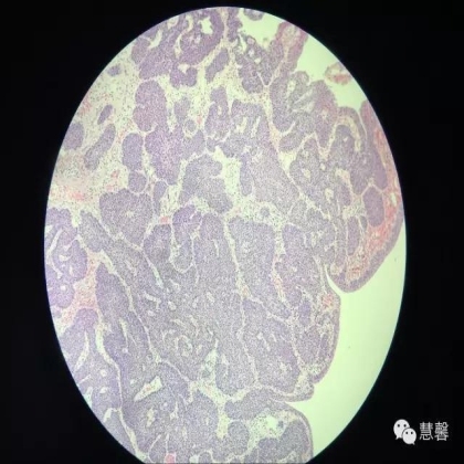 增殖性膀胱炎背景上的内翻性乳头状瘤（孔祥田(Max)*Roswell*NM]讲解）