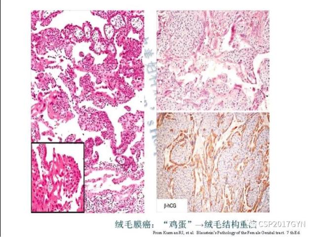 妊娠滋养细胞肿瘤的临床病理学进展