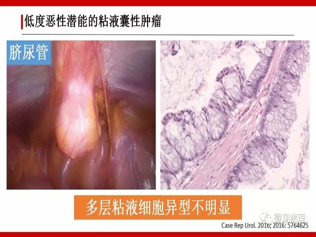 泌尿课程/尿路腺样病变的诊断要点