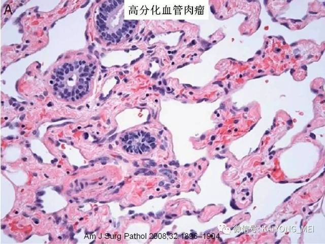 乳腺梭形细胞病变的病理诊断及进展（二）