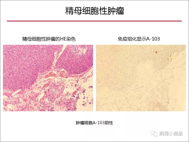 泌尿病理--精原细胞瘤VS精母细胞瘤