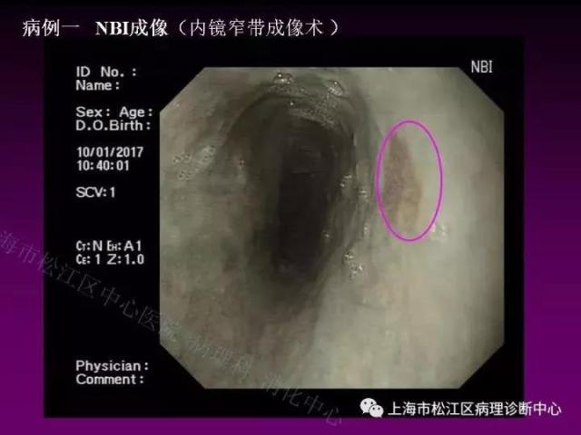 上消化道低级别上皮内瘤变的那些事