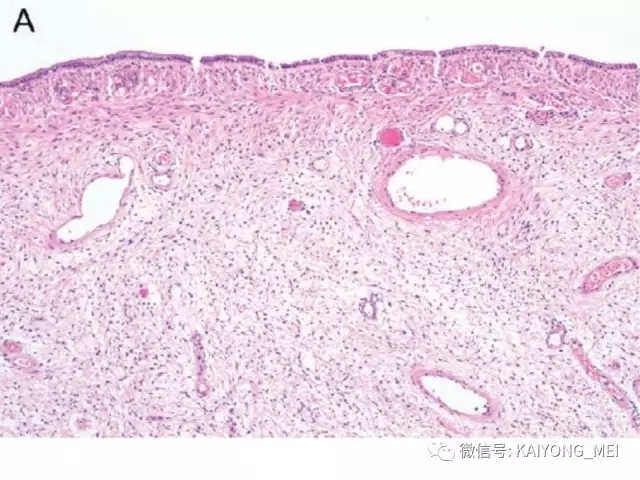 女性生殖道软组织肿瘤病理诊断及进展（一）