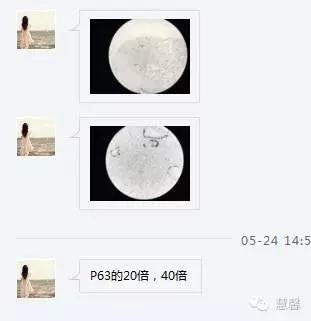 前列腺腺癌？（芳分享病例，华夏泌尿群讨论，孔祥田老师讲解）