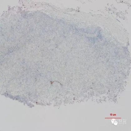 皮病性淋巴结炎，与格列卫治疗相关？（赵洋病例分享，华夏病理学术二群讨论）