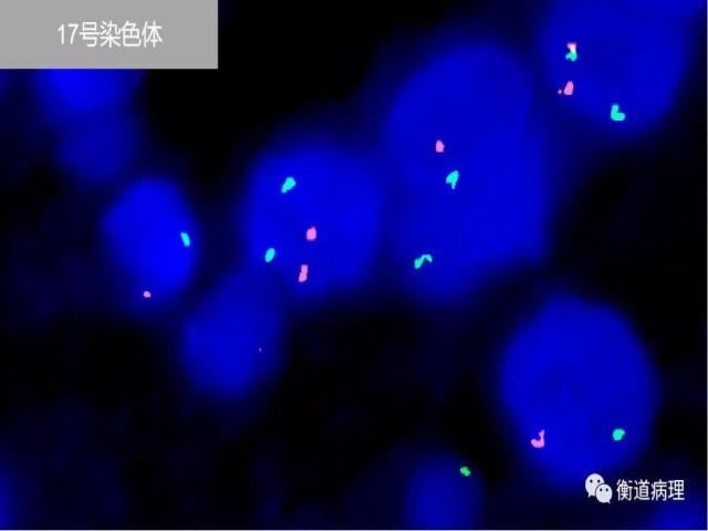 一例罕见分型肾脏肿瘤的病理解析