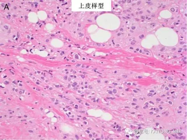 乳腺梭形细胞病变的病理诊断及进展（一）