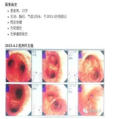 中日韩个体化诊疗案例大赛经典赏析之十四——27岁晚期NSCLC，精准治疗 与 指南盲区向左向右