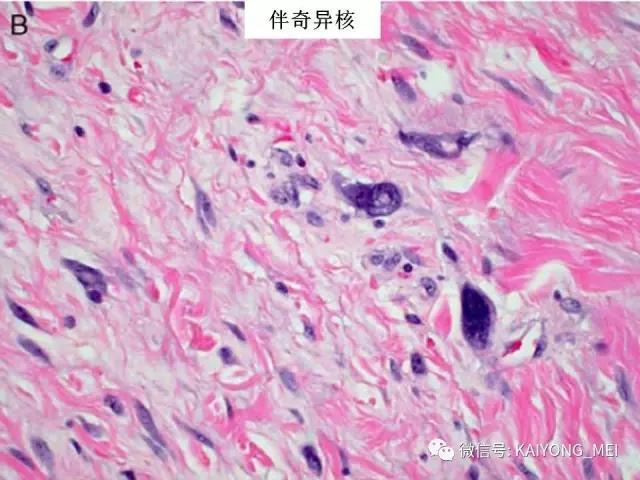 乳腺梭形细胞病变的病理诊断及进展（一）