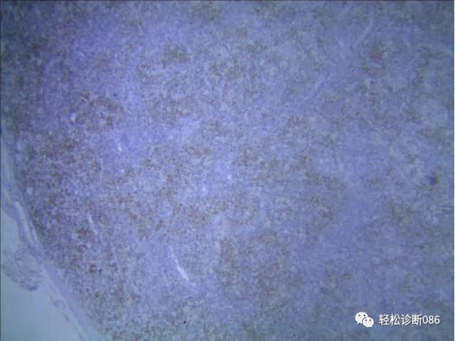 滤泡辅助T细胞（TFH）及其相关淋巴瘤（11）