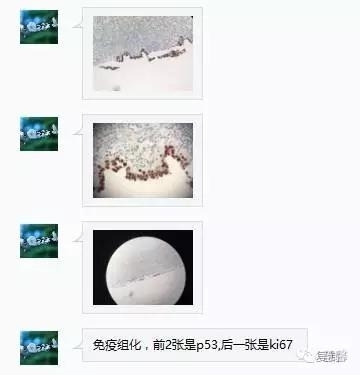 输卵管浆液性癌（张杰分享，孔祥田(Max)*Roswell*老师讲解）
