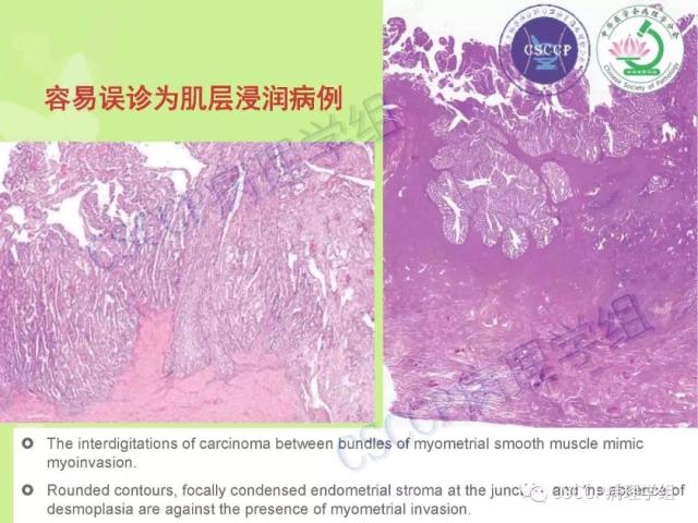 宫颈与子宫病变病理标本取材