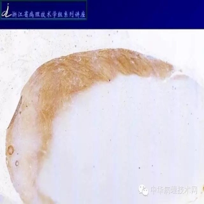 《常规免疫组化初筛ALK阳性非小细胞肺癌专家共识》技术部分解读