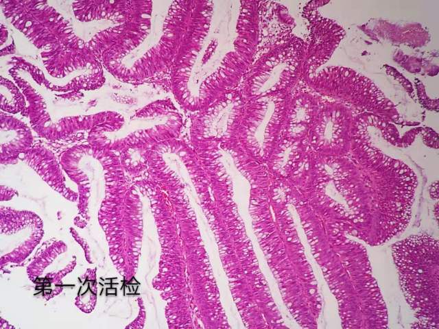 病理科工作札记（三十五）二次活检