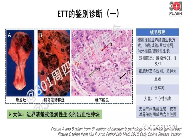 中间型滋养细胞肿瘤的诊断及鉴别诊断