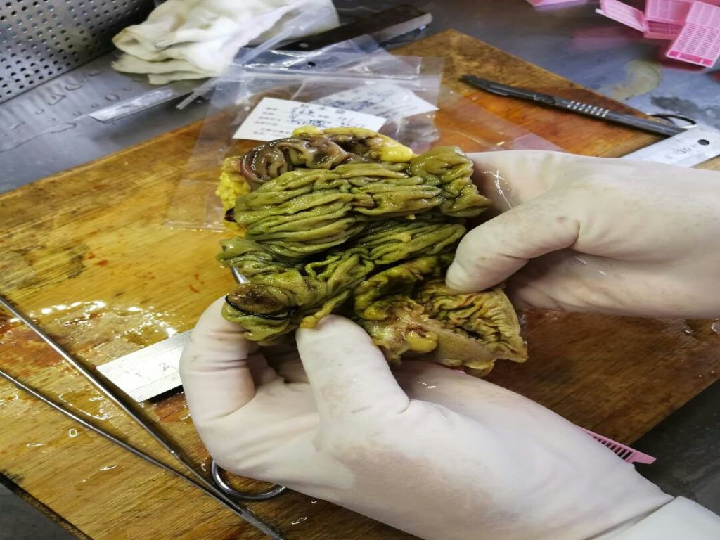 病理科工作札记（二十三）早期大肠癌