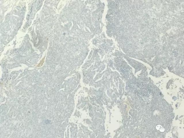 输卵管浆液性癌（张杰分享，孔祥田(Max)*Roswell*老师讲解）