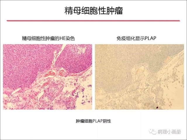 泌尿病理--精原细胞瘤VS精母细胞瘤