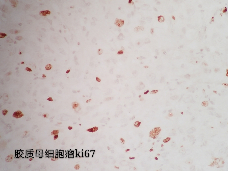 病理科工作札记（三十八）胶质母细胞瘤