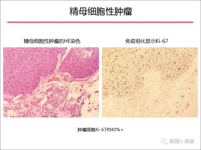 泌尿病理--精原细胞瘤VS精母细胞瘤