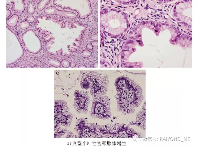 宫颈腺性病变的病理诊断及进展（一）