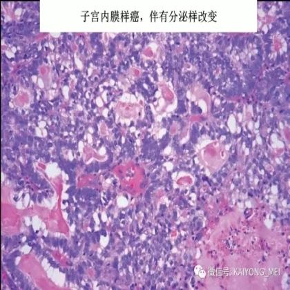 卵巢癌的病理诊断新进展（二）