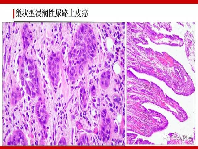 膀胱尿路上皮肿瘤诊断的一些困惑