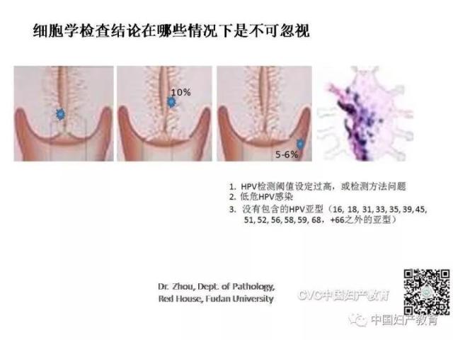 独家专访国内妇产科病理大咖周先荣教授：子宫颈上皮内病变及相关临床情况的若干病理学问题（一）