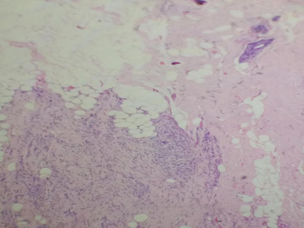 组织学1级的乳腺浸润性导管癌（札记七十五）